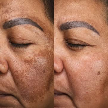 Venature Bakuchiol Retinol Rejuvenation Serum -30ml