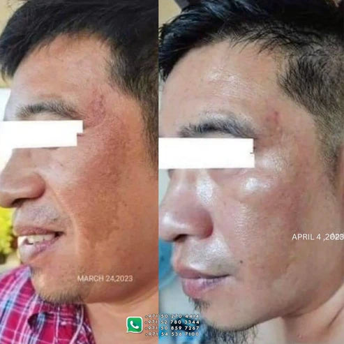 HerChoice Ph - Pekas Remover Cream -50g